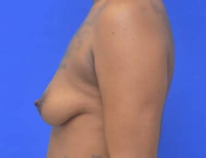 Breast Augmentation Before & After Gallery - Patient 171758 - Image 1