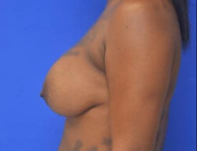 Breast Augmentation Before & After Gallery - Patient 171758 - Image 2