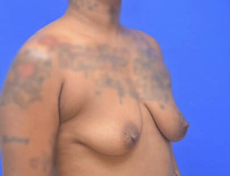 Breast Augmentation Before & After Gallery - Patient 171758 - Image 3