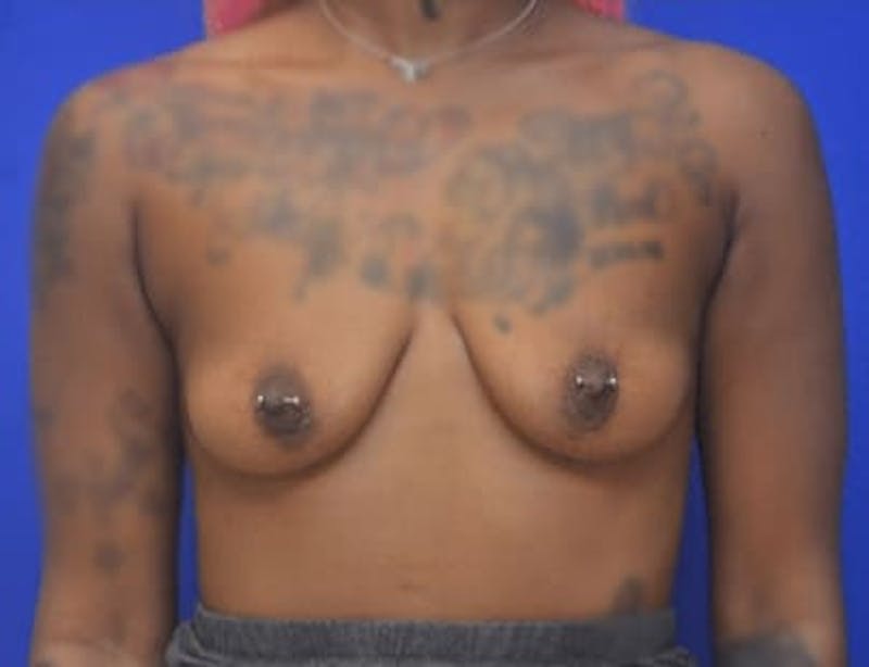 Breast Augmentation Before & After Gallery - Patient 171758 - Image 5