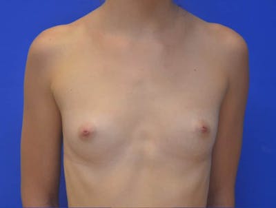 Breast Augmentation Before & After Gallery - Patient 286450 - Image 1