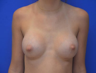 Breast Augmentation Before & After Gallery - Patient 286450 - Image 2