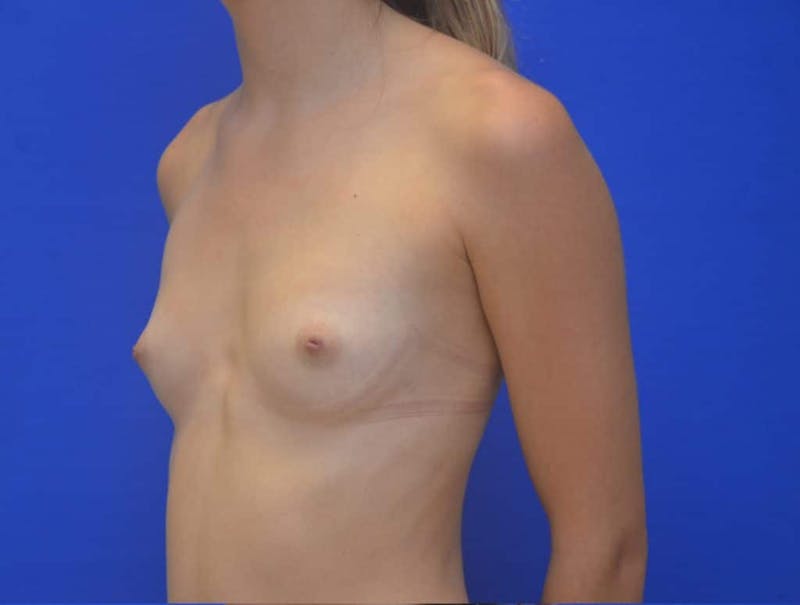 Breast Augmentation Before & After Gallery - Patient 286450 - Image 3