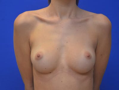 Breast Augmentation Before & After Gallery - Patient 264672 - Image 1