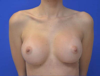 Breast Augmentation Before & After Gallery - Patient 264672 - Image 2