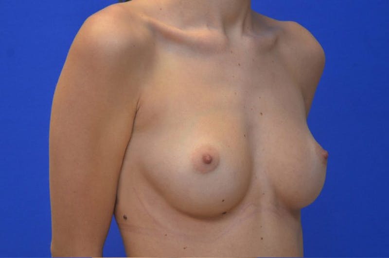 Breast Augmentation Before & After Gallery - Patient 264672 - Image 3
