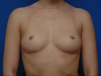 Breast Augmentation Before & After Gallery - Patient 320939 - Image 1