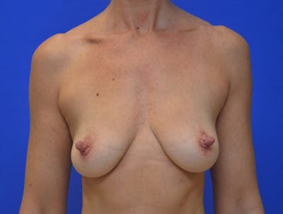 Breast Augmentation Before & After Gallery - Patient 370816 - Image 1