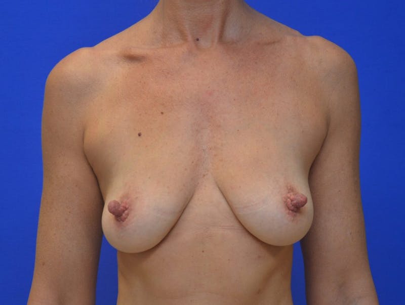 Breast Augmentation Before & After Gallery - Patient 370816 - Image 1