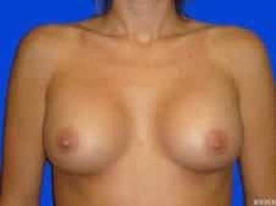 Breast Augmentation Before & After Gallery - Patient 960949 - Image 2