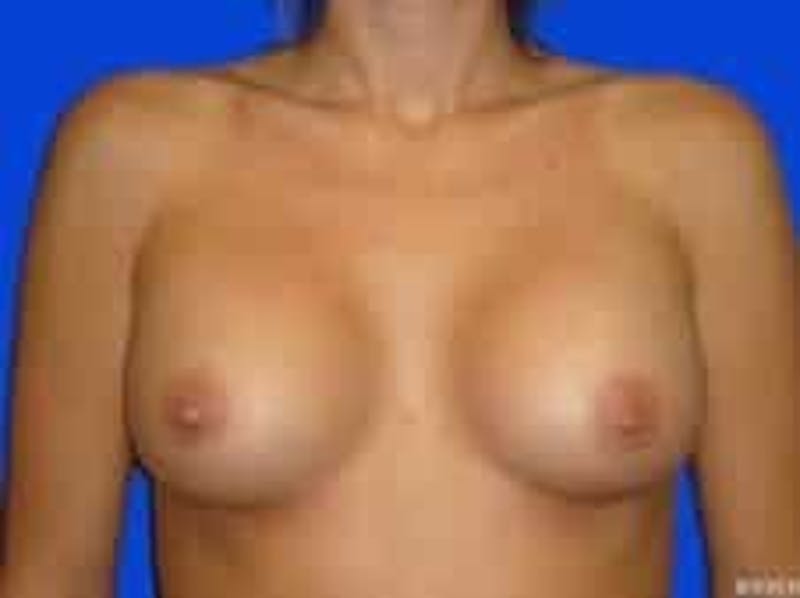 Breast Augmentation Before & After Gallery - Patient 960949 - Image 2