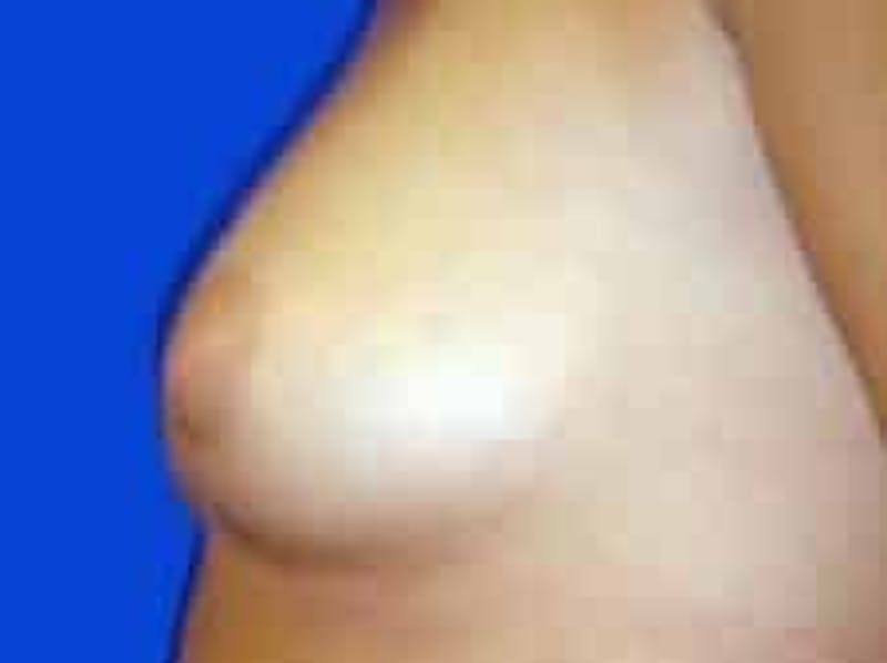 Breast Augmentation Before & After Gallery - Patient 960949 - Image 3