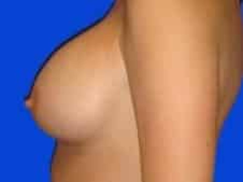 Breast Augmentation Before & After Gallery - Patient 960949 - Image 4