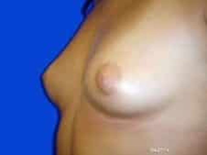 Breast Augmentation Before & After Gallery - Patient 960949 - Image 5