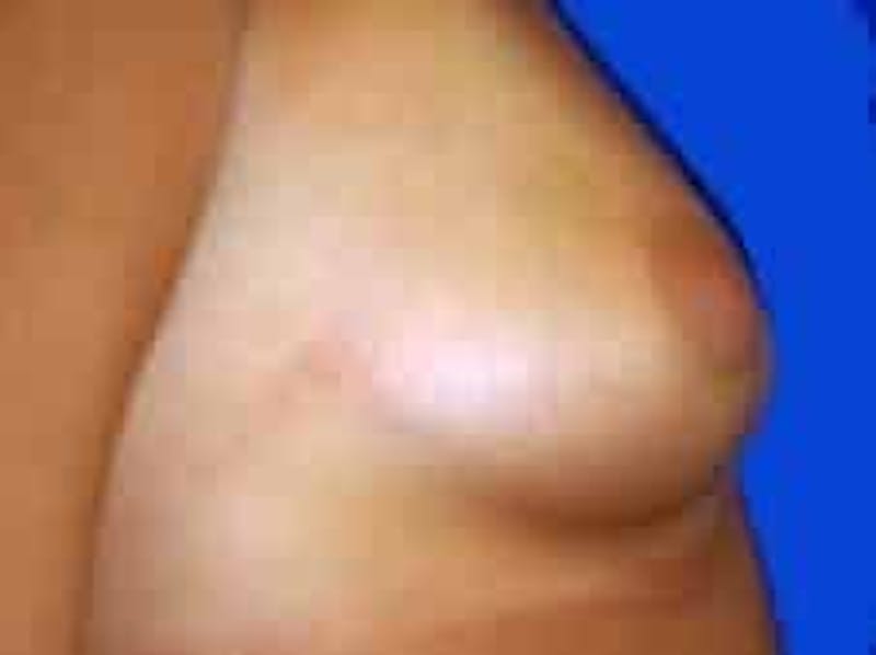 Breast Augmentation Before & After Gallery - Patient 960949 - Image 7