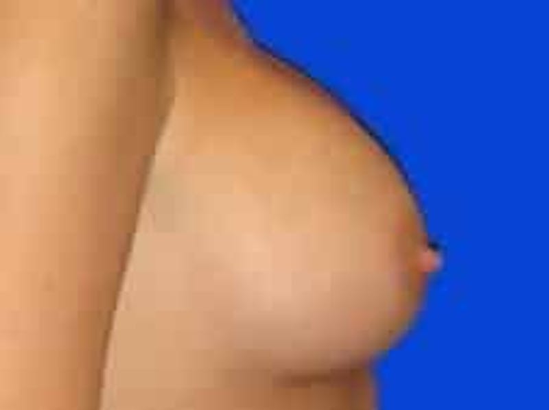Breast Augmentation Before & After Gallery - Patient 960949 - Image 8