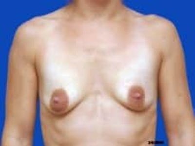 Breast Augmentation Before & After Gallery - Patient 127829 - Image 1