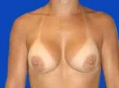 Breast Augmentation Before & After Gallery - Patient 127829 - Image 2