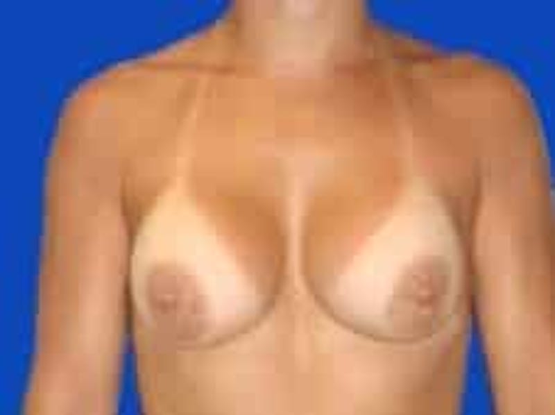 Breast Augmentation Before & After Gallery - Patient 127829 - Image 2