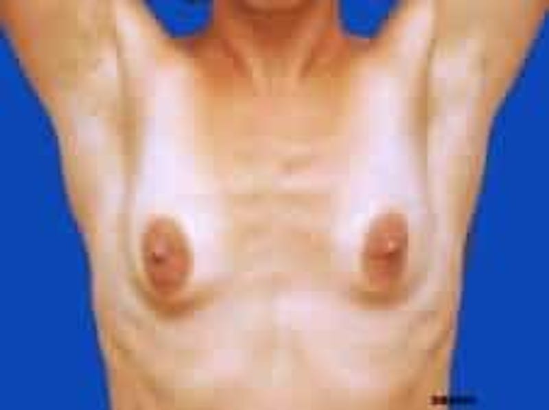 Breast Augmentation Before & After Gallery - Patient 127829 - Image 3