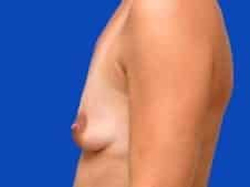 Breast Augmentation Before & After Gallery - Patient 127829 - Image 5