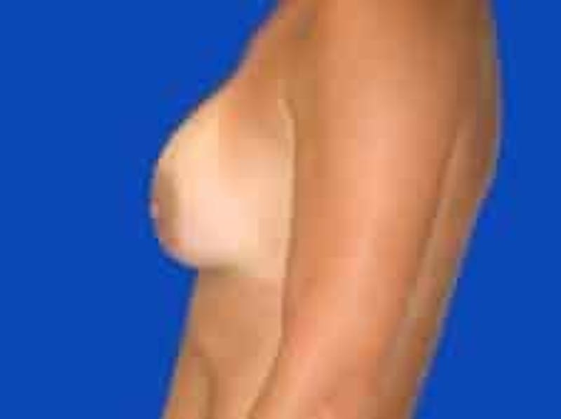 Breast Augmentation Before & After Gallery - Patient 127829 - Image 6
