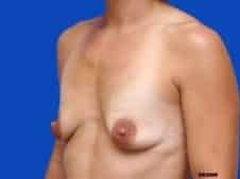 Breast Augmentation Before & After Gallery - Patient 127829 - Image 7