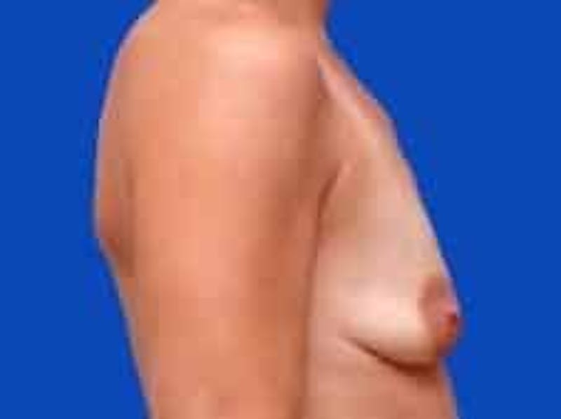 Breast Augmentation Before & After Gallery - Patient 127829 - Image 9