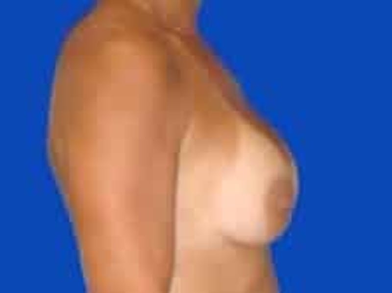 Breast Augmentation Before & After Gallery - Patient 127829 - Image 10