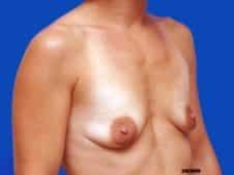 Breast Augmentation Before & After Gallery - Patient 127829 - Image 11
