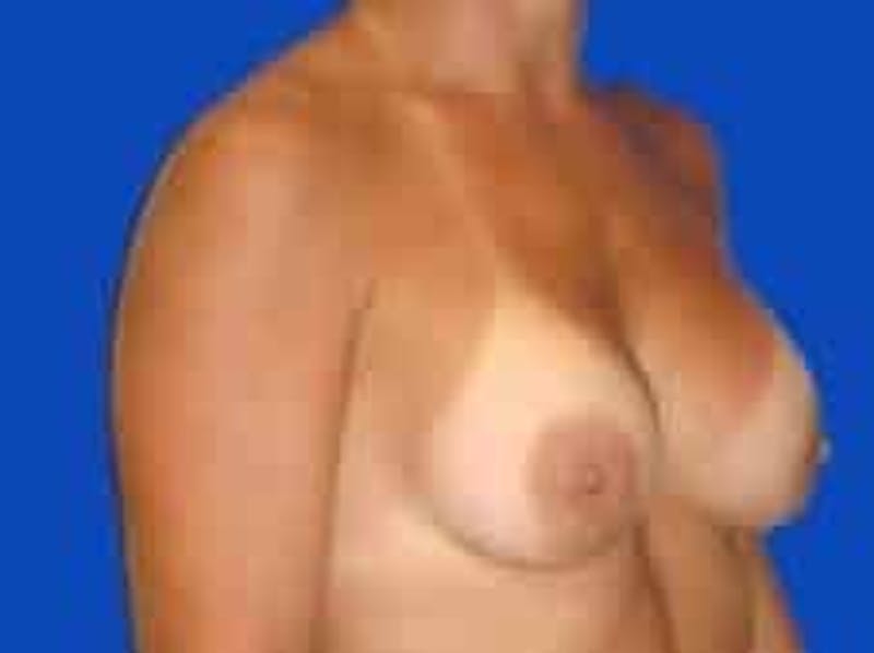 Breast Augmentation Before & After Gallery - Patient 127829 - Image 12