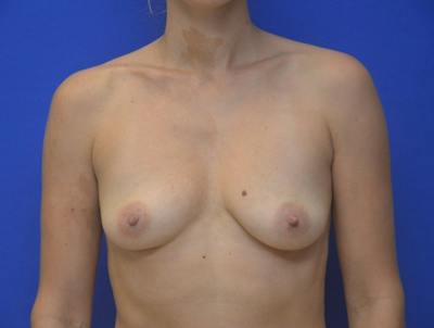 Breast Augmentation Before & After Gallery - Patient 113226 - Image 1
