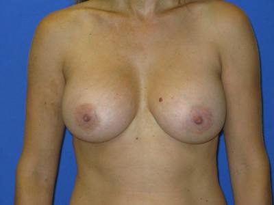 Breast Augmentation Before & After Gallery - Patient 113226 - Image 2