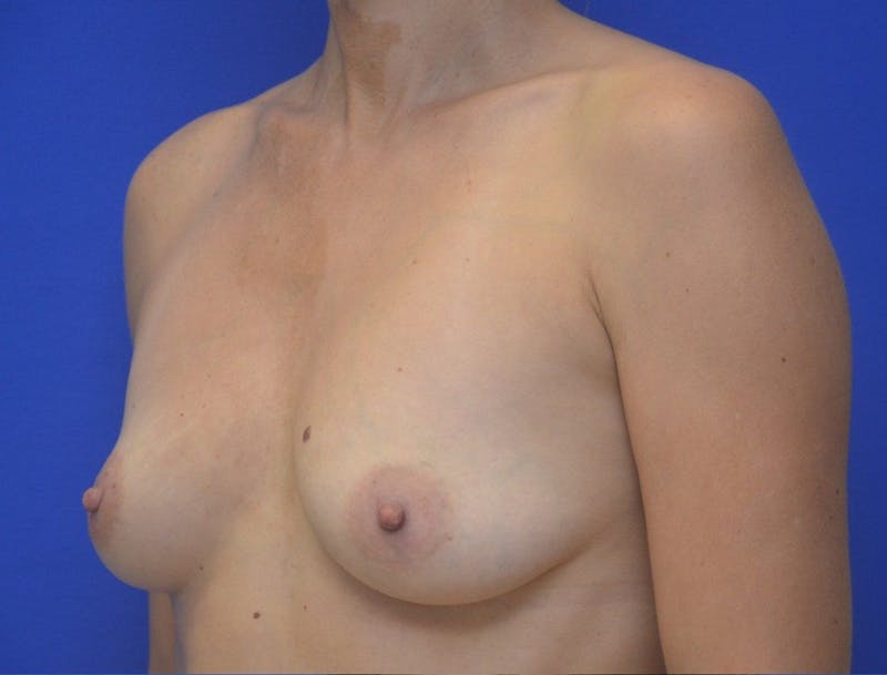Breast Augmentation Before & After Gallery - Patient 113226 - Image 3