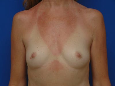 Breast Augmentation Before & After Gallery - Patient 831746 - Image 1