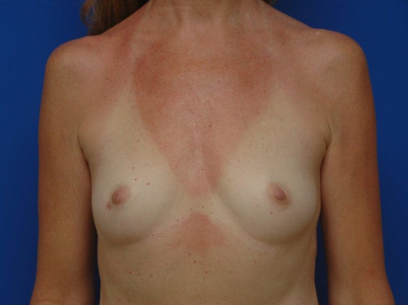 Breast Augmentation Before & After Gallery - Patient 831746 - Image 1