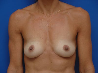 Breast Augmentation Before & After Gallery - Patient 163612 - Image 1