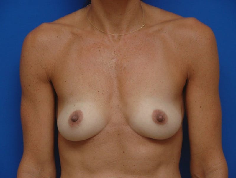 Breast Augmentation Before & After Gallery - Patient 163612 - Image 1