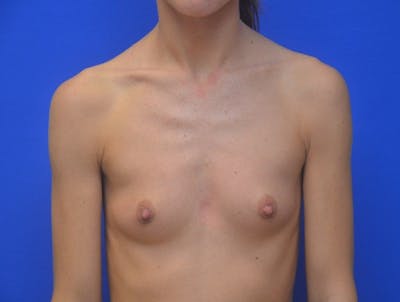 Breast Augmentation Before & After Gallery - Patient 241323 - Image 1
