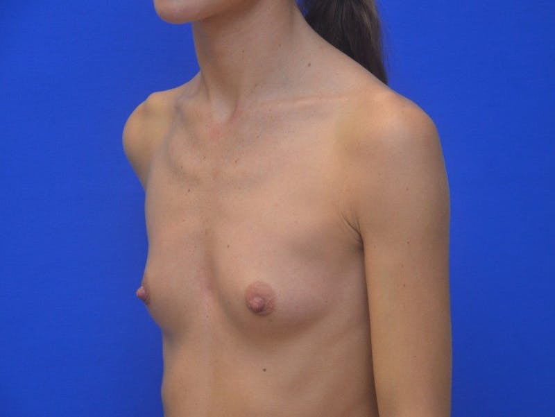 Breast Augmentation Before & After Gallery - Patient 241323 - Image 3