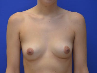 Breast Augmentation Before & After Gallery - Patient 791623 - Image 1