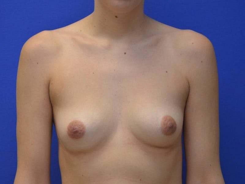 Breast Augmentation Before & After Gallery - Patient 791623 - Image 1