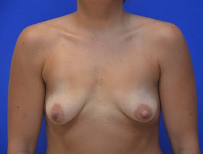 Breast Augmentation Before & After Gallery - Patient 324956 - Image 1