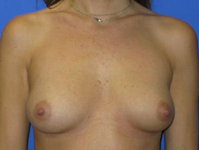 Breast Augmentation Before & After Gallery - Patient 172889 - Image 1
