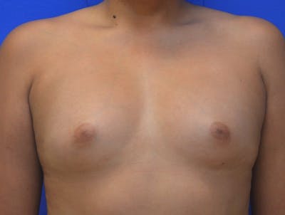 Breast Augmentation Before & After Gallery - Patient 364513 - Image 1