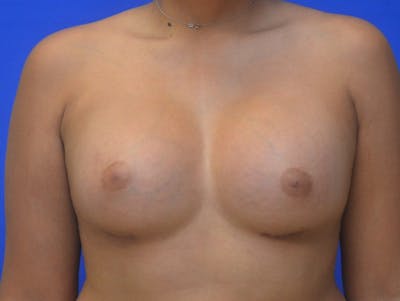 Breast Augmentation Before & After Gallery - Patient 364513 - Image 2