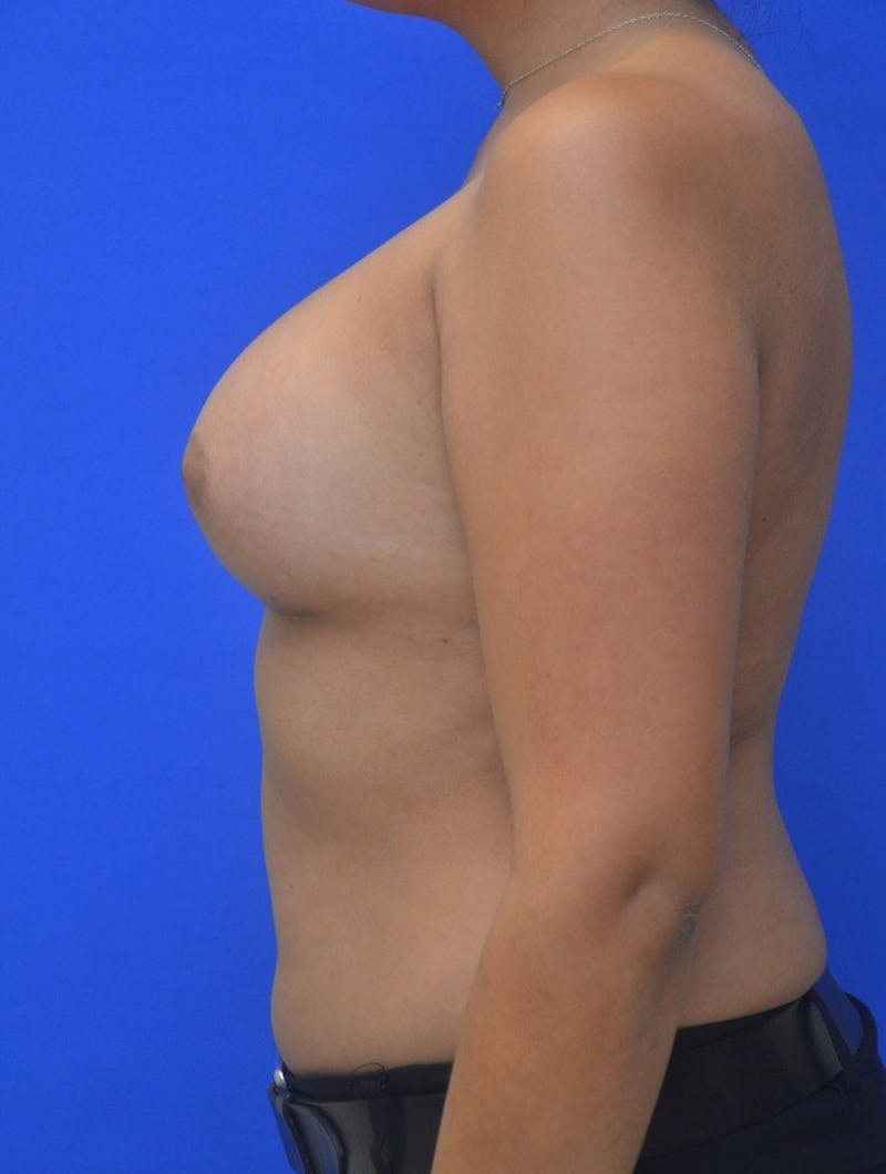 Breast Augmentation Before & After Gallery - Patient 364513 - Image 4