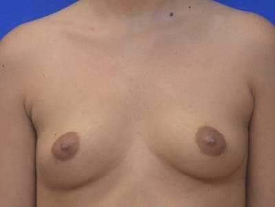 Breast Augmentation Before & After Gallery - Patient 422642 - Image 1