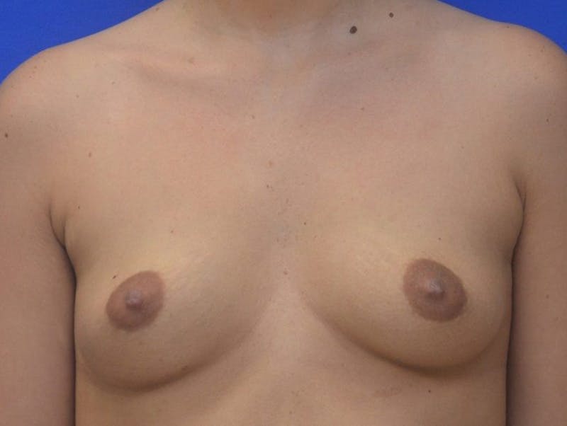 Breast Augmentation Before & After Gallery - Patient 422642 - Image 1