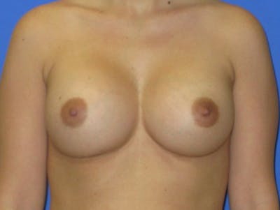 Breast Augmentation Before & After Gallery - Patient 422642 - Image 2